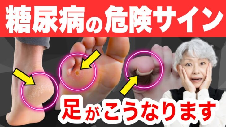 【知らないと後悔】糖尿病「足」の危険サイン。糖尿病は知らないうちに進行しています！