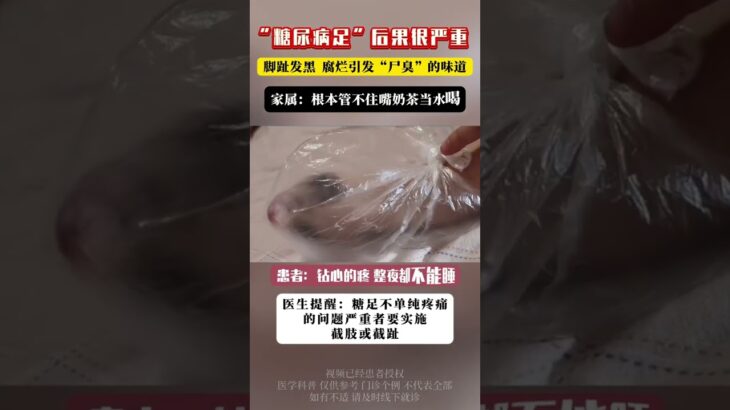 糖尿病足后果很严重，脚趾发黑腐烂引发“尸臭”的味道 抖出健康知识宝藏   开工去班味健康指南    沈阳二四二医院  王强教授  糖尿病足