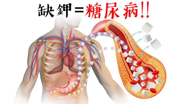 缺钾导致糖尿病,柏格医生