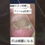 #巻き爪#胼胝#フットケア#糖尿病#下肢切断#アンプタ#CLTI#包括的高度慢性下肢虚血