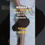 15天治疗糖尿病足噩梦？脚趾发黑、溃疡、疼痛难忍——血管修复和草药缓解拯救了我的脚！#糖尿病 #糖尿病足 #康复之旅#糖尿病经典方