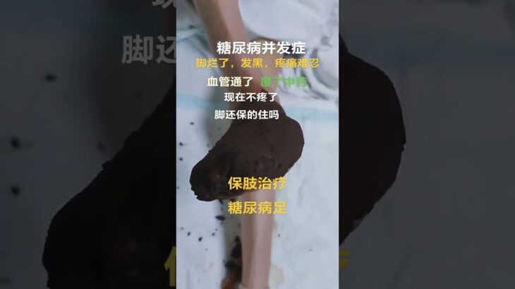 15天治疗糖尿病足噩梦？脚趾发黑、溃疡、疼痛难忍——血管修复和草药缓解拯救了我的脚！#糖尿病 #糖尿病足 #康复之旅#糖尿病经典方