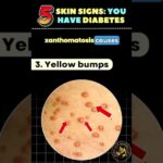 5 Skin Signs Of Diabetes | Don’t Ignore These Signs #skincare #diabeticawareness #short