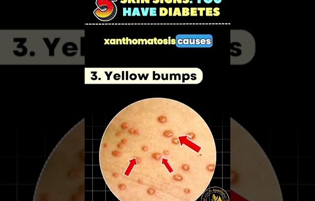 5 Skin Signs Of Diabetes | Don’t Ignore These Signs #skincare #diabeticawareness #short