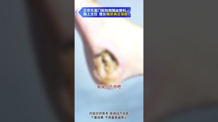【糖足保肢门诊】50岁透析患者足跟溃烂，保肢难度有多大？ #糖尿病 #糖足保肢  #糖尿病治疗  #糖尿病足  #鞠上