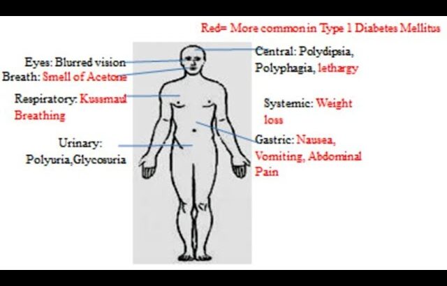Clinical Features of Diabetes Mellitus (Signs and symptoms, Clinical presentation)