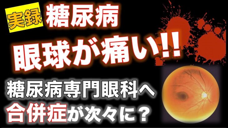 【実録 糖尿病】眼球が痛い!! 糖尿病専門眼科へ　合併症が次々に？