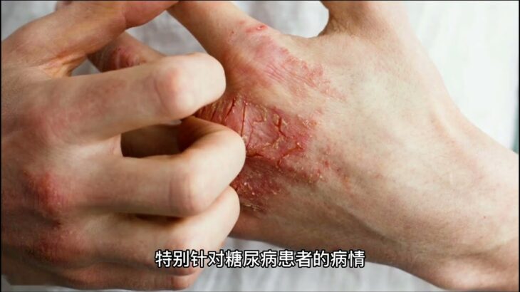 沉默的“杀手”糖尿病，可能在慢慢与我们靠近。糖尿病主要由多种因素，中医既可以通过中药调理，针灸治疗等手段有效预防糖尿病，降低高血糖的风险。 #二型糖尿病 #中医 #中药 #针灸