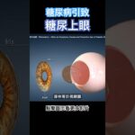 糖尿病引致糖尿上眼！ #白內障 #飛蚊症 #青光眼 #視力模糊