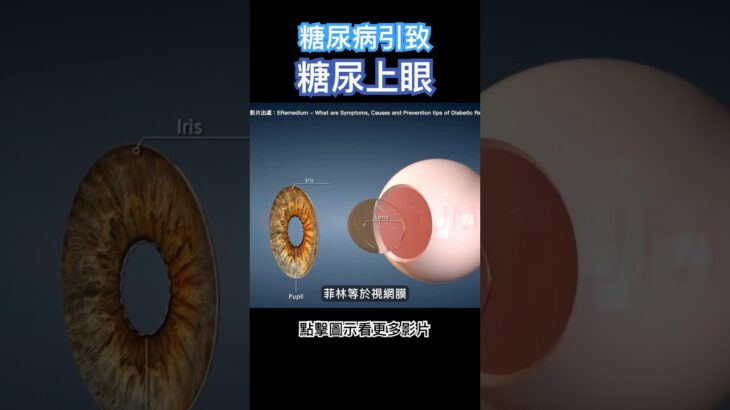 糖尿病引致糖尿上眼！ #白內障 #飛蚊症 #青光眼 #視力模糊