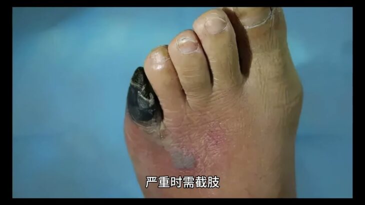 糖尿病的并发症