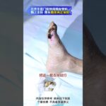 【糖足保肢查房】脚趾已截又坏死！快清创别拖少花冤枉钱 #糖尿病 #糖足保肢  #糖尿病治疗  #糖尿病足  #鞠上