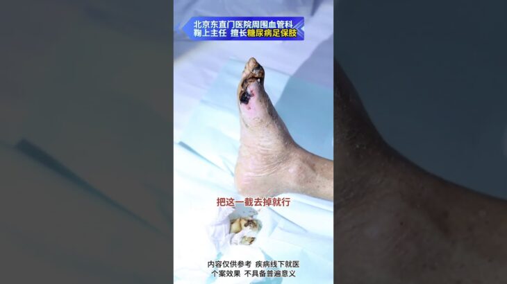 【糖足保肢查房】脚趾已截又坏死！快清创别拖少花冤枉钱 #糖尿病 #糖足保肢  #糖尿病治疗  #糖尿病足  #鞠上