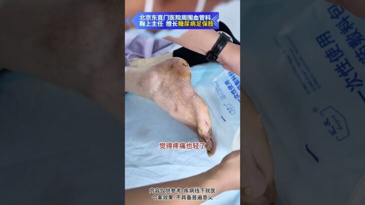 【糖足保肢查房】又要保肢 又要省钱 医生处处为患者着想 #糖尿病 #糖足保肢  #糖尿病治疗  #糖尿病足  #鞠上