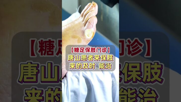 【糖足保肢门诊】唐山患者来的及时  保肢有希望 #糖尿病 #糖足保肢  #糖尿病治疗  #糖尿病足  #鞠上