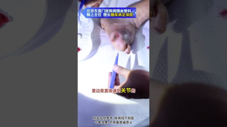 【糖足保肢查房】脚趾出现小黑洞，看似小问题，其实骨头烂光了 #糖尿病 #糖足保肢  #糖尿病治疗  #糖尿病足  #鞠上