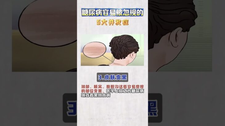 糖尿病容易被忽视的5大并发症 #抖出健康知识宝藏  #解锁春日健康清单  #在抖音pick你的健康搭子  #王强教授 #糖尿病并发症