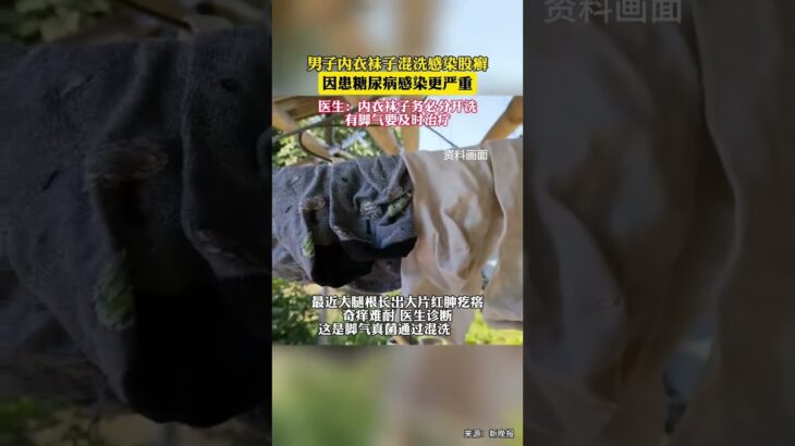 60岁大爷内衣袜子混洗感染股癣，因患糖尿病感染更严重#糖尿病 #感染 #内衣 #股藓