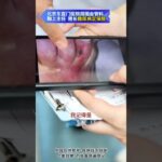 【糖足保肢查房】恢复不错！您的脚保住了 #糖尿病 #糖足保肢  #糖尿病治疗  #糖尿病足  #鞠上