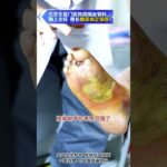 【糖足保肢门诊】紧急预警⚠️别让烂脚走到截肢这一步！ #糖尿病 #糖足保肢  #糖尿病治疗  #糖尿病足  #鞠上