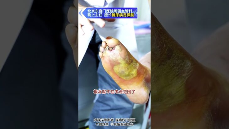 【糖足保肢门诊】紧急预警⚠️别让烂脚走到截肢这一步！ #糖尿病 #糖足保肢  #糖尿病治疗  #糖尿病足  #鞠上