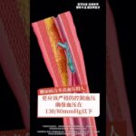 糖尿病本身不可怕可怕的是它和高血压联合作案 医生讲明白肾衰脑梗是怎么一步步来的#抖出健康知识宝藏#医学科普#高血压#糖尿病#阿利沙坦酯氨氯地平片