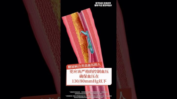 糖尿病本身不可怕可怕的是它和高血压联合作案 医生讲明白肾衰脑梗是怎么一步步来的#抖出健康知识宝藏#医学科普#高血压#糖尿病#阿利沙坦酯氨氯地平片