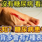 人有沒有糖尿病，看腳背先知？糖尿病患者，腳背多會有7種表現