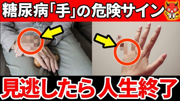 【放置厳禁】知らないと一生後悔…糖尿病で起きやすい「手」のやばすぎるSOSサインとは…【糖尿病・網膜症・神経障害】