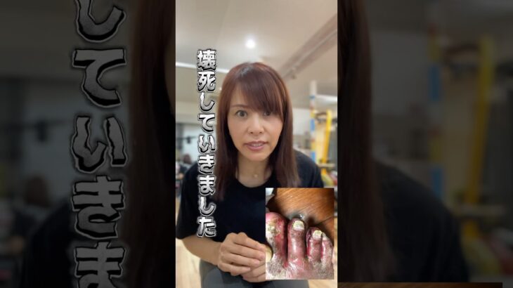 気づきにくい！糖尿病の前兆サイン合併症で足が壊死