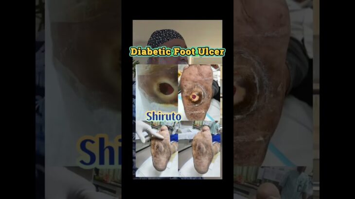 Amazing #shiruto testimony #diabetic foot #ulcer 60179949657 #immunesystem #kencingmanis #糖尿病 #ippa1