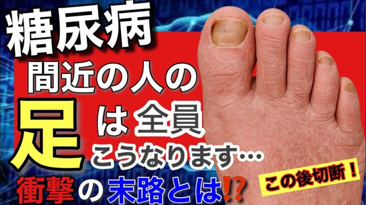【衝撃】糖尿病間近の人の足は全員こうなります！ちょっとした変化でも見落とすと足切断です。