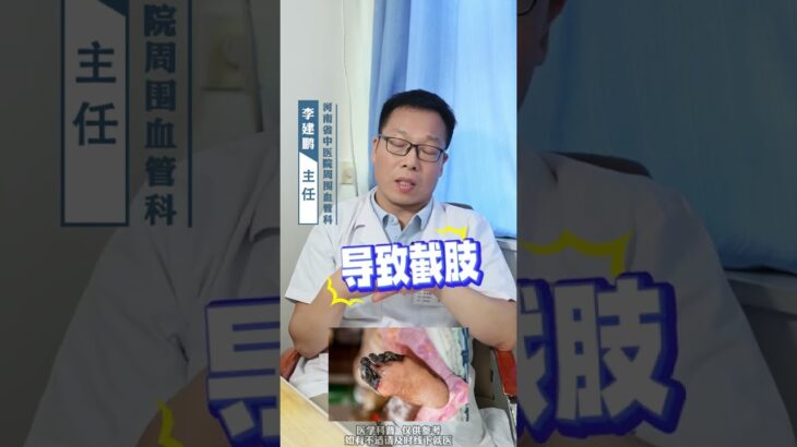 脚趾发黑溃疡可能是糖尿病足发出的信号 #健康科普有真知 #医学科普 #抖出健康知识宝藏 #静脉曲张