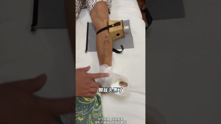 糖尿病足就怕等，及时医治保腿脚 #抖出健康知识宝藏 #健康科普有真知 #医学科普 #静脉曲张