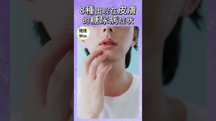 8種出现在皮膚的糖尿病症状，癢不停、總感染？別再怪膚質差，你可能該驗血糖了，前兆？不能忽視的症狀 ，你的身體正提醒你血糖失控 | 健康Wise
