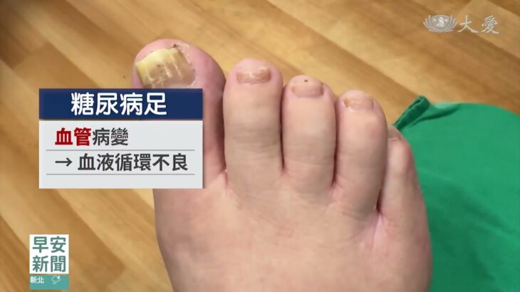 糖尿病足傷口無感覺 潰爛惡化恐截肢
