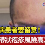 糖尿病患者要留意！ 罹患帶狀疱疹風險高2倍