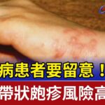糖尿病患者要留意！ 罹患帶狀皰疹風險高2倍