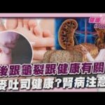 腳後跟龜裂跟健康有關! 重症醫曝光恐是糖尿病 全麥吐司高纖超健康? 腎病注意動脈鈣化危機20251015｜主播#王馨儀 ｜1700健康儀點靈 PODCAST｜TVBS新聞