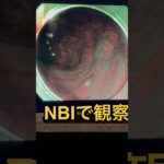 秒殺大腸ポリープ#過敏性腸症候群#脂質異常症#糖尿病#痛風#高血圧#内視鏡といえば天白橋#天白橋内科内視鏡クリニック#名古屋市#天白区#胃カメラ#大腸カメラ#大腸内視鏡検査#内科#内科もやっぱり天白橋