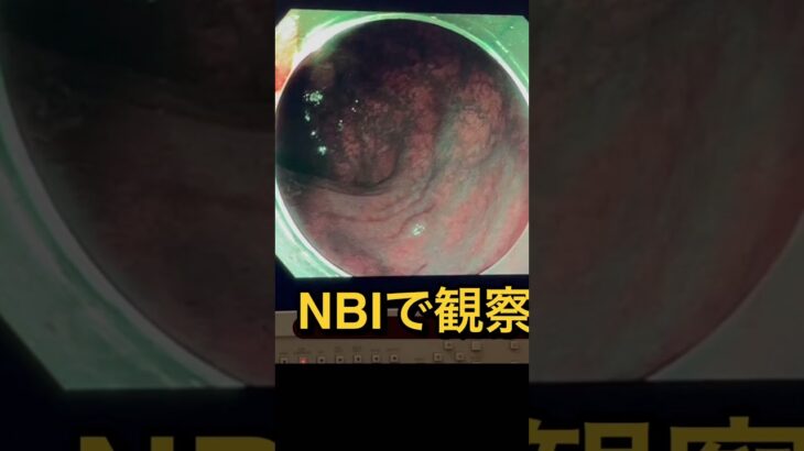 秒殺大腸ポリープ#過敏性腸症候群#脂質異常症#糖尿病#痛風#高血圧#内視鏡といえば天白橋#天白橋内科内視鏡クリニック#名古屋市#天白区#胃カメラ#大腸カメラ#大腸内視鏡検査#内科#内科もやっぱり天白橋