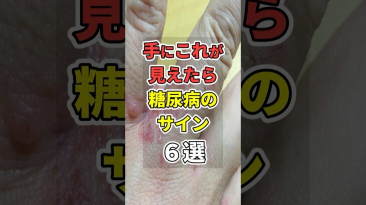 【9割が知らない】手に”コレ”が見えたら糖尿病のサイン６選！　#あなたの健康を守るライフハック　 #健康 #雑学  #医療 #糖尿病   #shorts