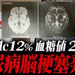 【糖尿病通院の自己中断】大変なことになりました【現役糖尿病内科医】