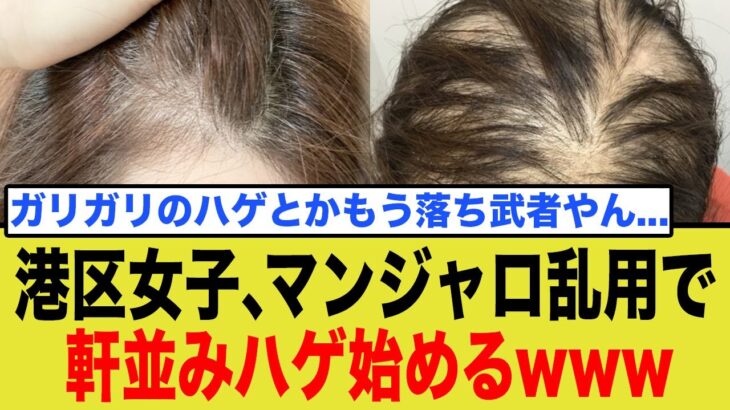 糖尿病治療薬『マンジャロ』、使用者たちが次々とハゲ始める衝撃の副作用がヤバすぎる…