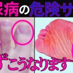 【医師監修】絶対に見逃してはいけない「糖尿病で起きやすい足の危険サイン」症状から予防法まで徹底的に解説します
