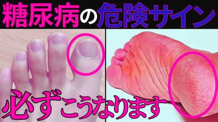 【医師監修】絶対に見逃してはいけない「糖尿病で起きやすい足の危険サイン」症状から予防法まで徹底的に解説します