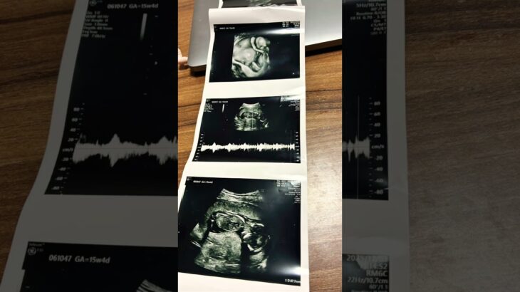 産婦人科でした！高血圧も糖尿病もなく赤ちゃんも順調で問題無しです！大事なところ隠れてたので性別はまた次回です💦眠そうでバンザイして顔の上に腕乗せてる赤ちゃんでした👶#妊娠中 #15週 #妊娠初期