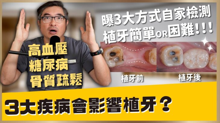 高血壓、糖尿病、骨質疏鬆會影響植牙嗎？牙周病撐越久，植牙越困難？醫師告訴你黃金時間點！醫師教你在家自我判斷 3 大關鍵｜【祐民牙醫－隱適美旗艦店】鑽石級楊大為醫師 #高血壓 #糖尿病 #骨質疏鬆