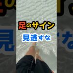 糖尿病の足の合併症｜初期サイン3つ