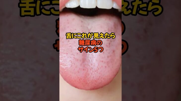 舌にこれが見えたら糖尿病のサイン5つ　　　　　　　　　　#健康 #健康雑学  #糖尿病 #健康生活VOICEVOX: 青山龍星